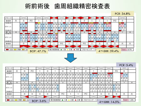 歯周病治療後の結果