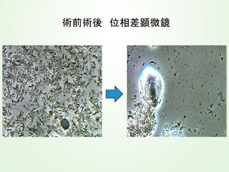 歯周病治療後の結果