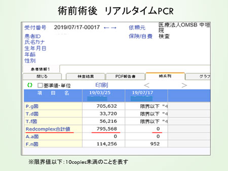 歯周病治療後の結果