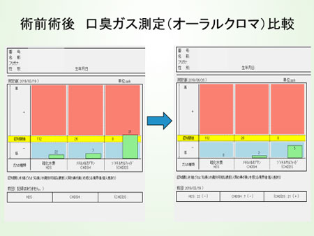 歯周病治療後の結果